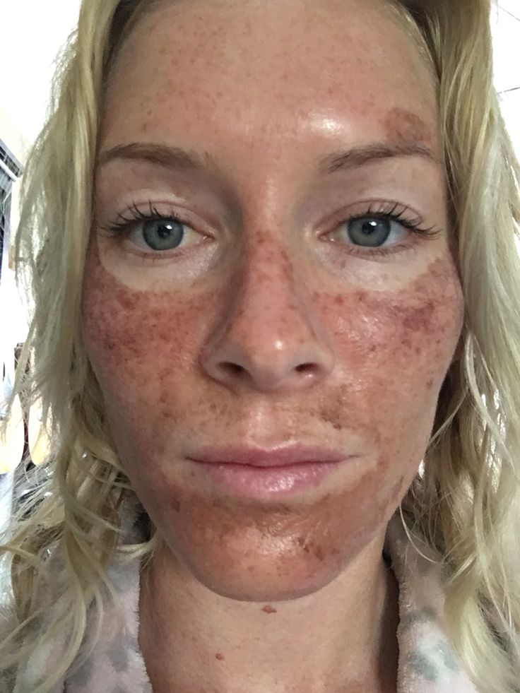 Lactic Acid Peel Burn